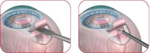 SETX Glaucoma – EX-PRESS® Glaucoma Filtration Device